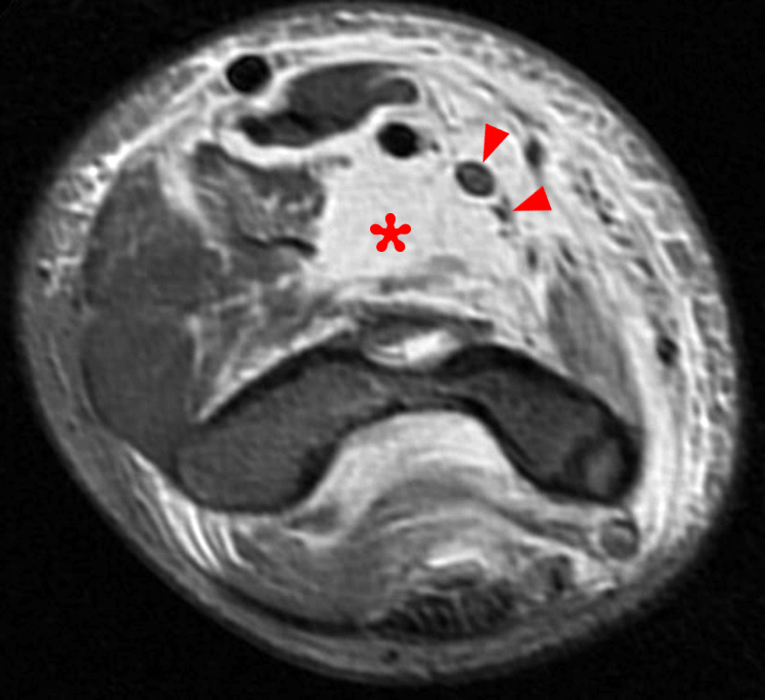 T2-weighted axial image