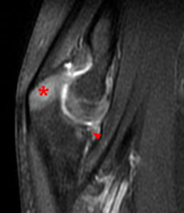 Fat-suppressed proton-density-weighted sagittal image