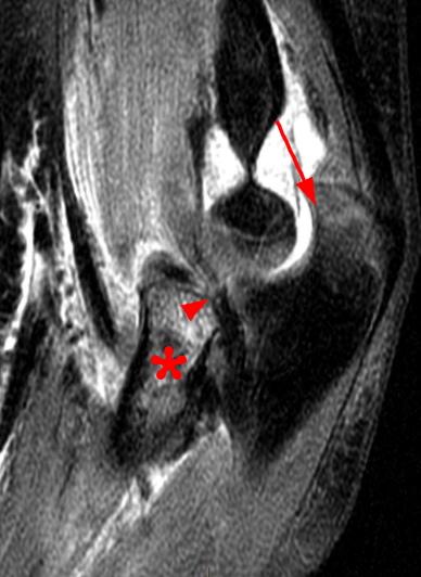 Sagittal fat-suppressed T2-weighted image