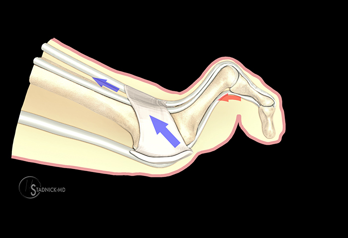 Toe Deformity Illustration