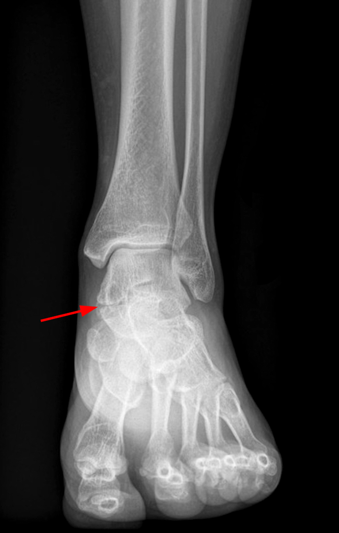 sustentaculum tali lateral x ray heel