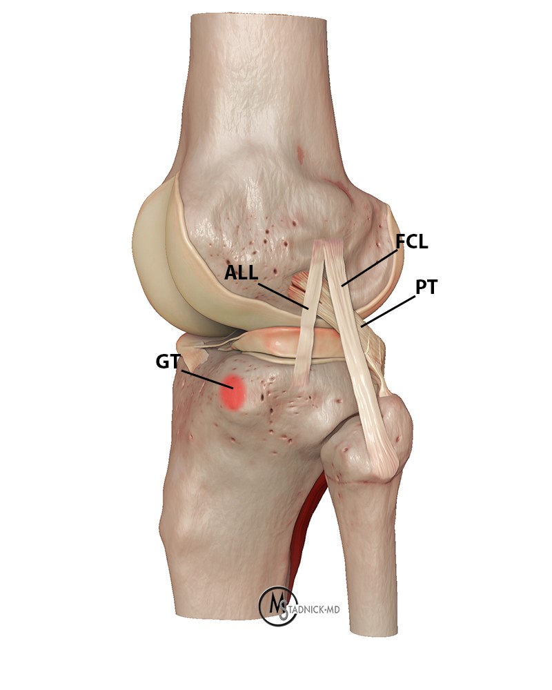 Anterolateral Ligament Tear