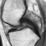 The Anterior Meniscofemoral Ligament of the Medial Meniscus