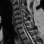 Spinal Cord Cavernous Malformation