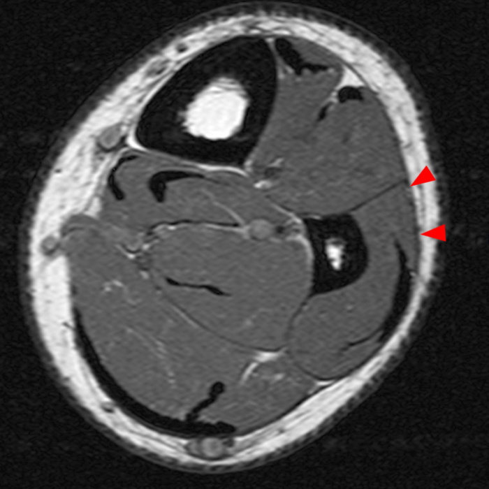 Muscle hernia in a 40-year-old man with a tender palpable mass at