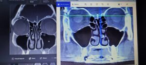 Radiology Rewind Fridays: Computed Tomography (CT) Scans