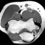 Cubital Tunnel Syndrome