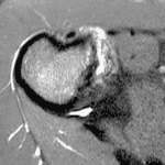 HAGL Lesions and Direct Subscapularis Muscle Attachment Injuries