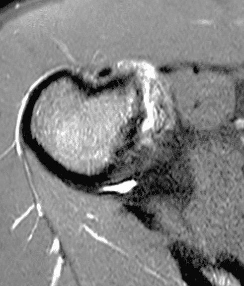 HAGL Lesions and Direct Subscapularis Muscle Attachment Injuries