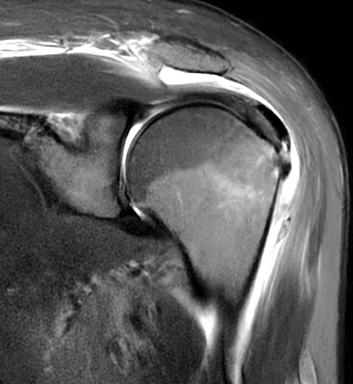 Basic Calcium Phosphate Crystal Deposition Disease