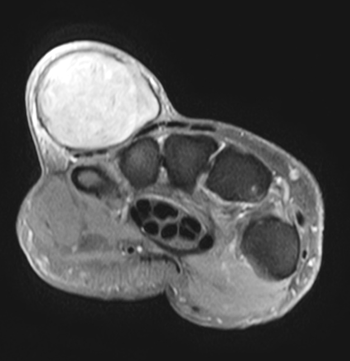 Epidermoid Inclusion Cyst