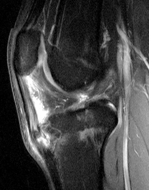 Osgood-Schlatter Disease