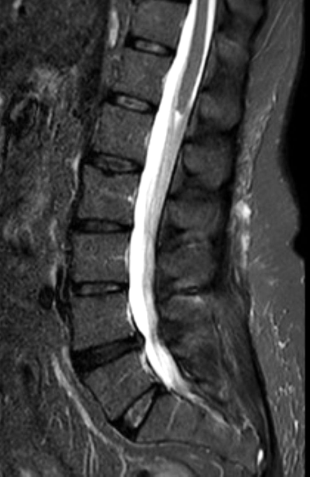 Caudal Regression Syndrome